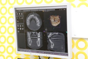CTモニター（3D画像）
